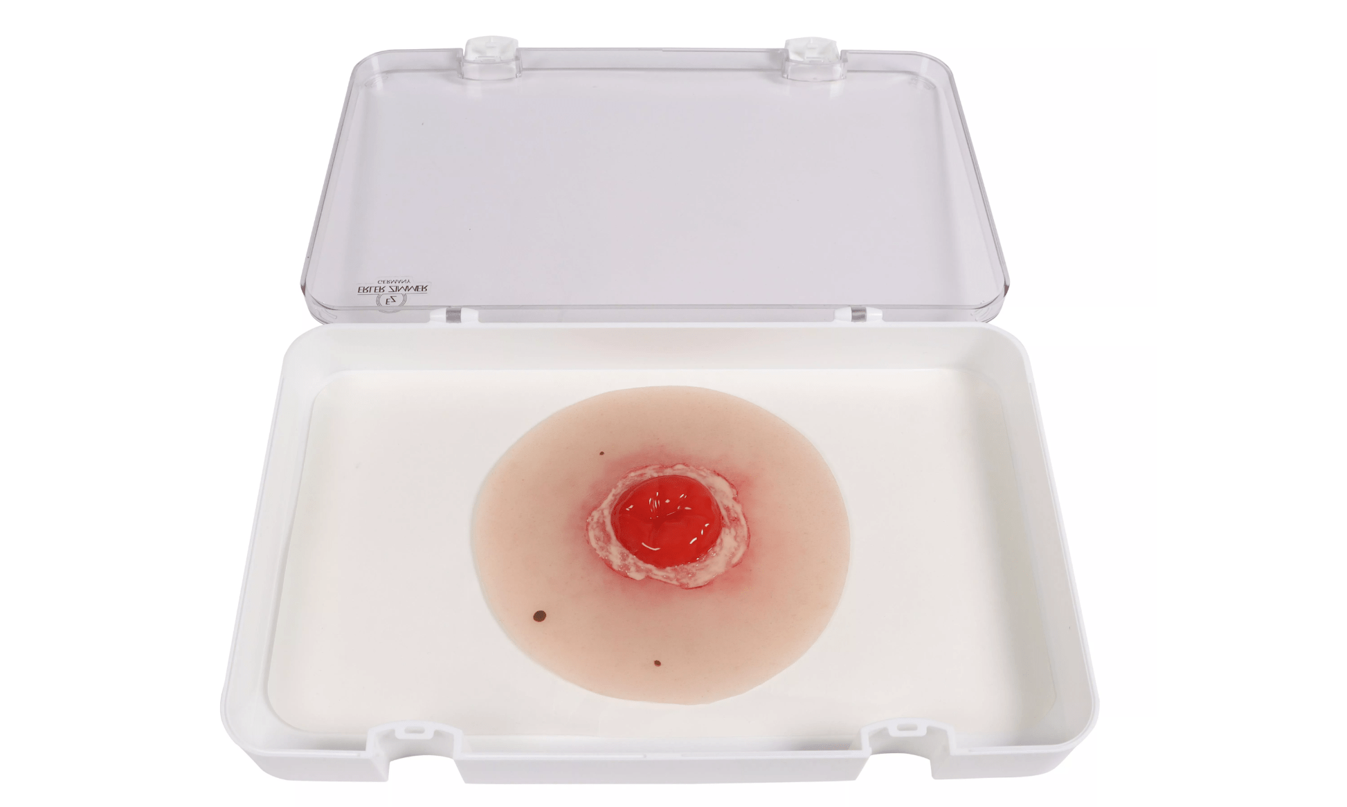 Wundmoulage Kolostoma entzündet, selbsthaftend - Erler - Zimmer